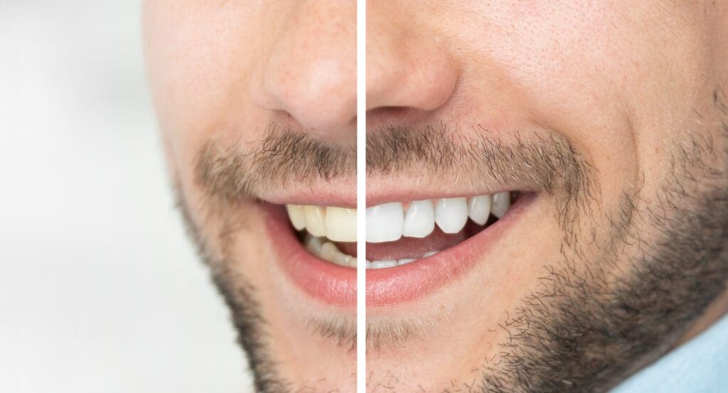 Teeth Whitening in Washington DC