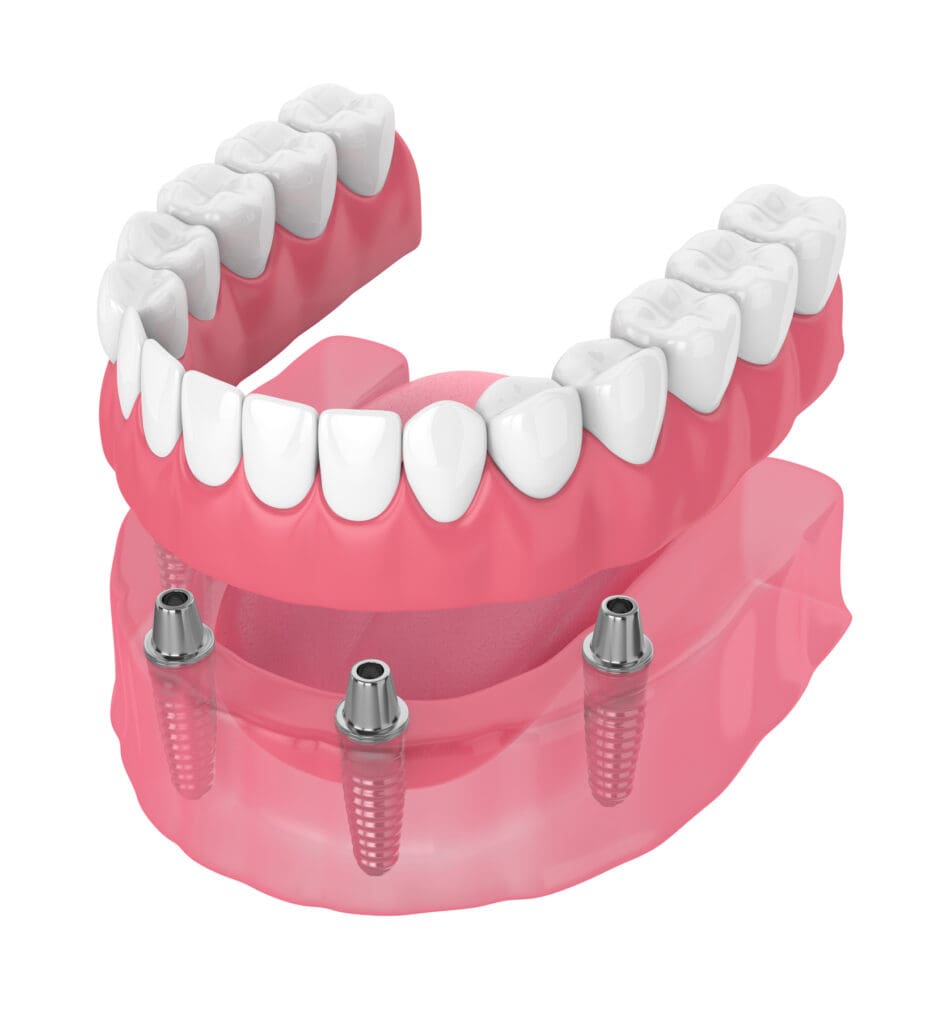 DENTAL IMPLANTS in WASHINGTON DC can be a lengthy and involved process