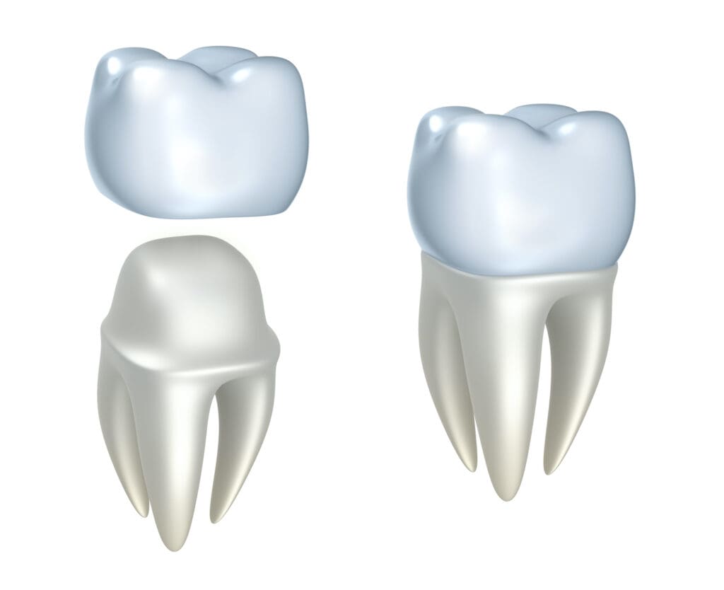 With the right aesthetic attention, dental crowns in Washington, DC, could blend seamlessly with your existing teeth.