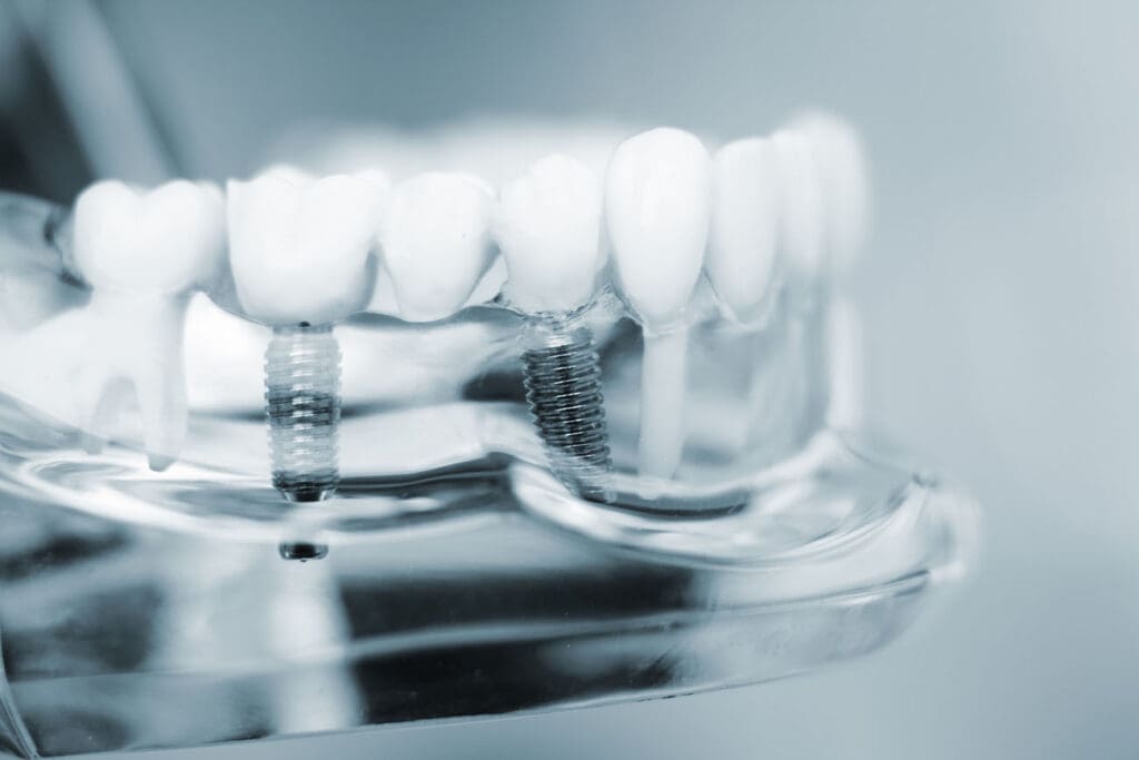 Dental implants could not only restore your smile but also ensure the functionality and health of your mouth.