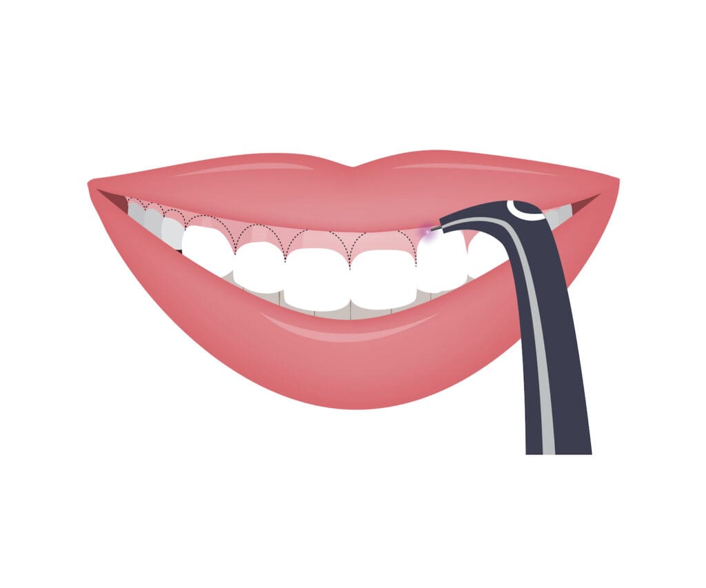 Laser dentistry is becoming more popular in dental practices due to its precision, comfort, and effectiveness.