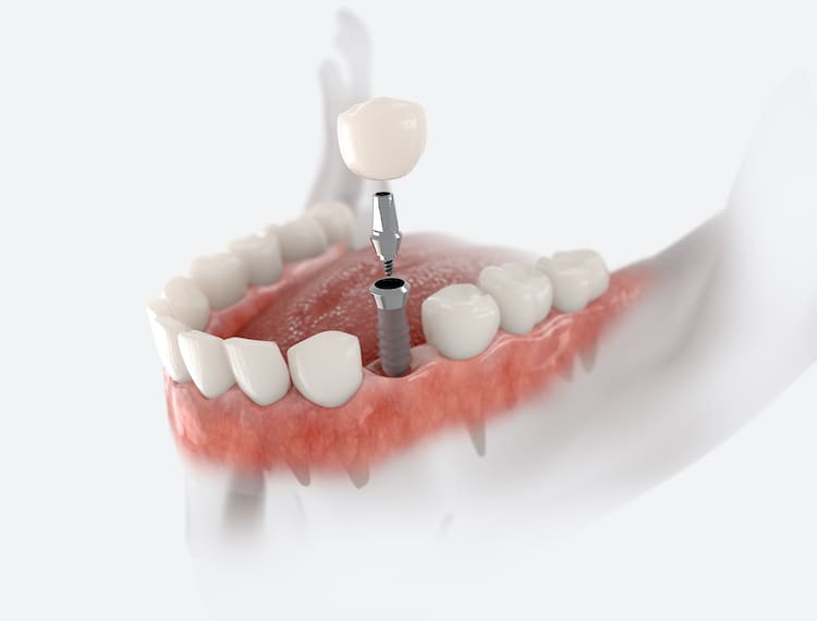 A dental implant offers numerous benefits over traditional dentures or bridges, including stability, longevity, and bone preservation.