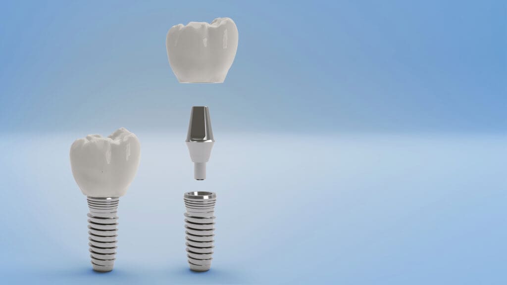 Dental Implants Dupont Dental DC