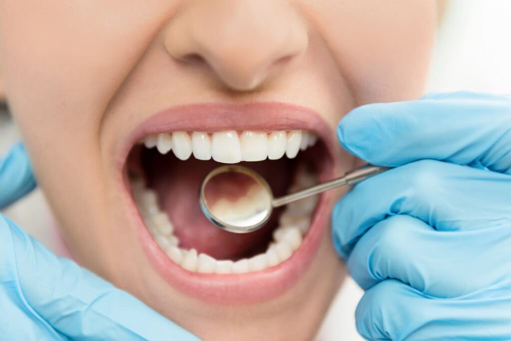 Treat a Tooth Cavity in Washington DC