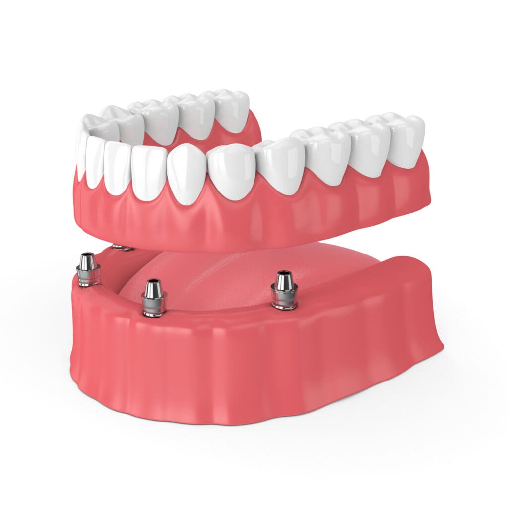 Implant Dentures Washington DC